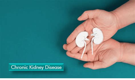 Cronic Kidney Disease - CKD Treatment By Ayurveda - For all 5 Stages - tem
