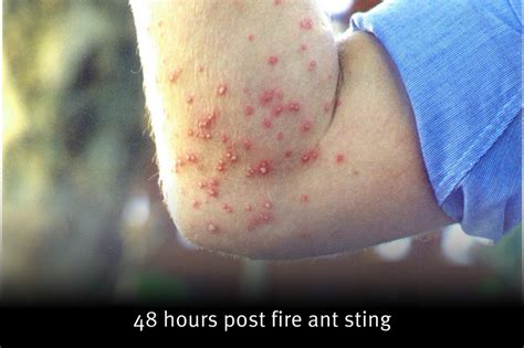 Stings | National Fire Ant Eradication Program