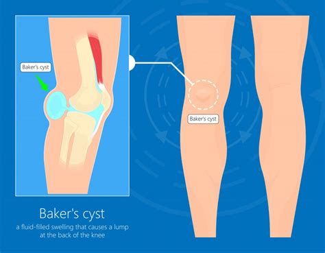 Common Knee Injuries - My Family Physio