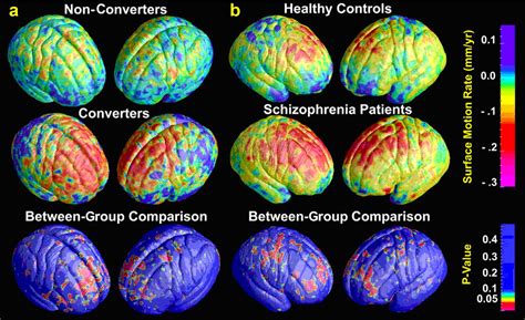 Schizophrenia brain structure abnormalities