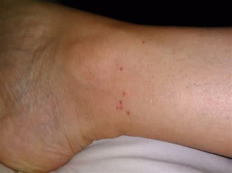 Tiny Red dots around my ankle??(pic not nasty) | BabyCenter