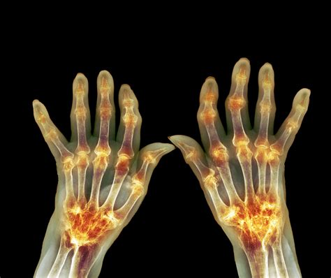 Case Study: Cardiac Manifestations of Rheumatoid Arthritis - The Cardiology Advisor