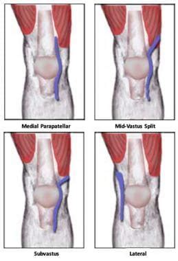 Minimally Invasive Total Knee Arthroplasty Technique: Minimally Invasive Approaches to Total ...