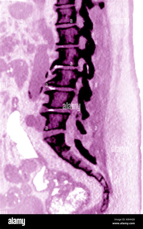 VERTEBRAL OSTEOARTHRITIS, CT-SCAN Stock Photo - Alamy