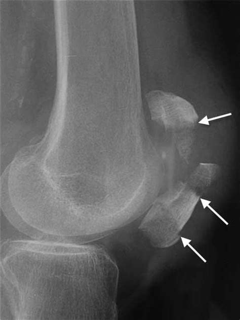 Patellar Fractures (Broken Kneecap) - OrthoInfo - AAOS