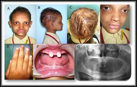 Ectodermal Dysplasia Teeth