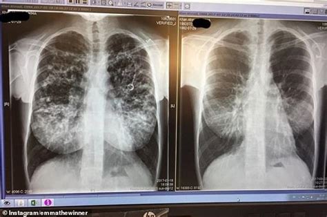 Cystic fibrosis sufferer had a DOUBLE lung transplant aged 22 | Daily ...