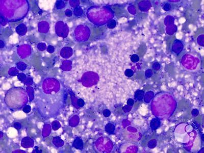 Figure 05: Trephine biopsy showing foamy macrophages with abundant ...