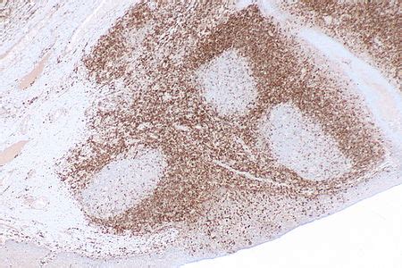 B-cell CLL/lymphoma 2 - Libre Pathology