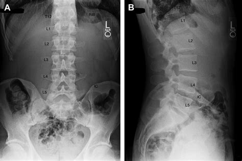 Lumbosacral Transitional Segments - Physical Medicine and Rehabilitation Clinics