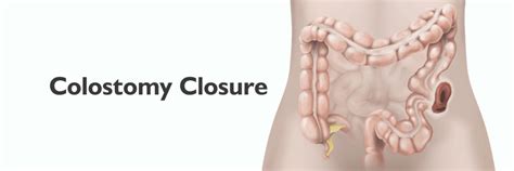 Colostomy Closure: Preparation, Procedure & Recovery