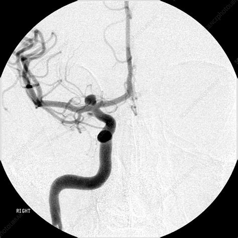 Cerebral Angiogram of Aneurysm - Stock Image - C027/0872 - Science ...