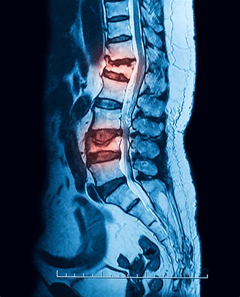 Vertebral Compression Fracture Treatment in NJ and NYC | Premier Brain & Spine