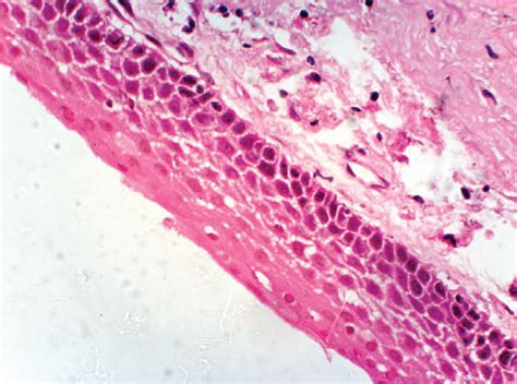 Histological features of dentigerous showing inflamed 4-6 layered non... | Download Scientific ...