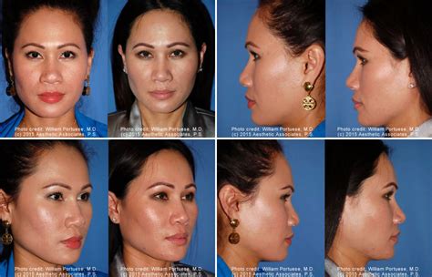 Flat Nose Before and After Photo Gallery - Nose Surgery Photos