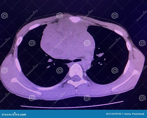 CT Scan Mass at Interior Mediastinum Stock Image - Image of care ...