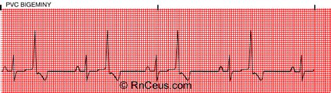 Want Transient President pvc premature ventricular contraction money ...