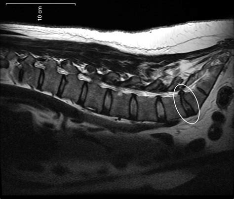 Disc protrusion - Wikipedia