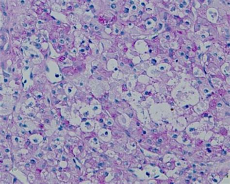 Chondrosarcoma - Pathology - Orthobullets