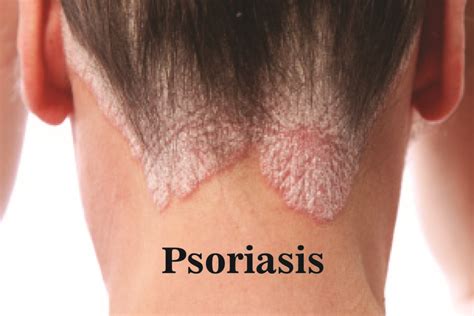 Psoriasis : Symptoms, Causes and Treatment - Dr. Anki Reddy's