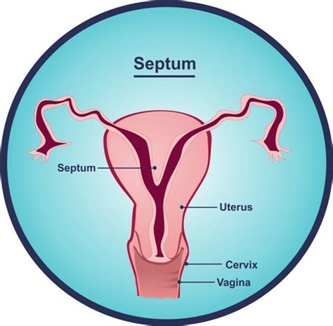 What is a Uterine Septum?