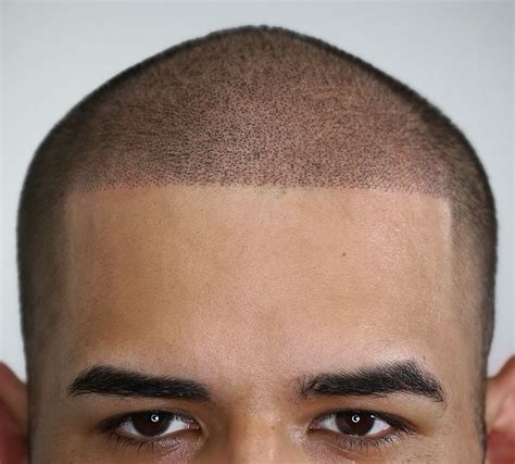 Pin on Scalp Micro Pigmentation Procedures