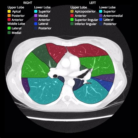 Bronchopulmonary segments: annotated CT | Radiology Case | Radiopaedia.org