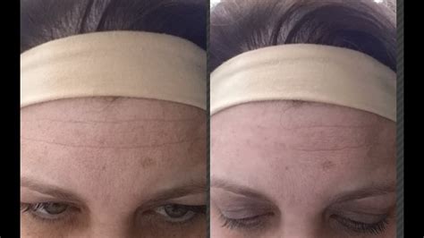 Crazy Before After Back to Before Forehead Wrinkle Cream - Disappear in 2 Minutes! - YouTube