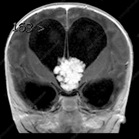 MRI Choroid Plexus Papilloma in Infant - Stock Image - C043/3058 - Science Photo Library