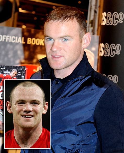 Wayne Rooney hair transplant insights! - My Blog | Wayne rooney hair transplant, Hair transplant ...