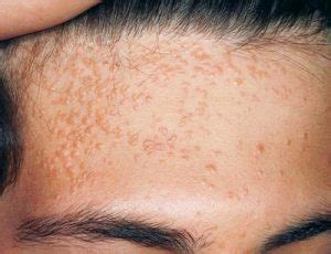 Flat Warts: Symptoms, Causes, and Ways of Treatment - Med Warts