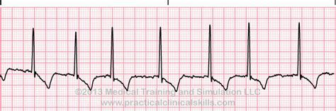 atrial fibrillation ekg strip