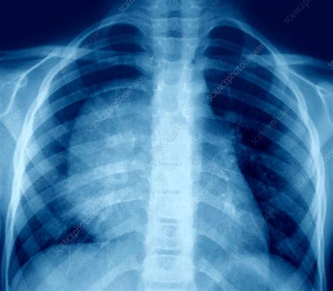 Hydatid cyst, lung X-ray - Stock Image - C037/3068 - Science Photo Library