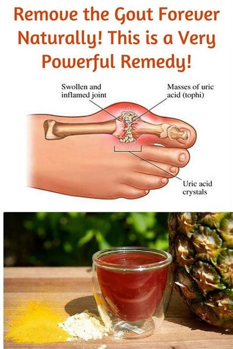 Remove the Gout Forever Naturally! This is a Very Powerful Remedy! #arthritisrelie… | Natural ...