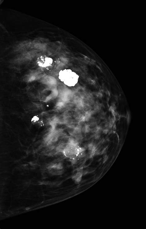 Fibroadenoma other imaging findings - wikidoc