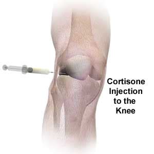 College Joints: The Cortisone Injection