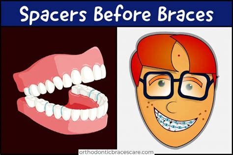 Does everyone need spacers before braces | Orthodontic Braces Care