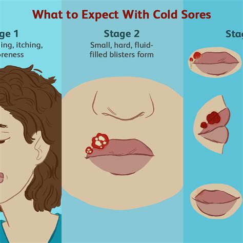 Stages Of Cold Sores On Lips