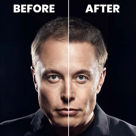 Elon Musk Hair Transplant Turkey | Amazing Result - 2024