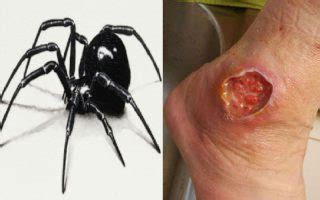 Black Widow Bite – Causes Symptoms Treatments & Important Details