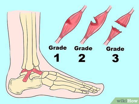 4 Ways to Treat a Sprained Ankle - wikiHow