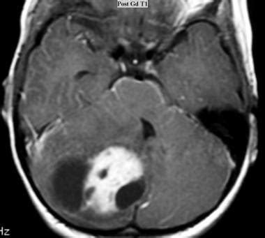 Juvenile Pilocytic Astrocytoma Imaging: Practice Essentials, Computed Tomography, Magnetic ...