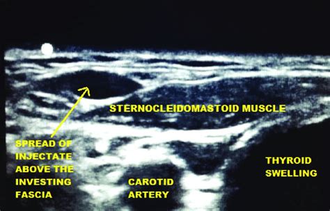 Superficial Cervical Plexus Block And Ultrasound Guided Styloid Process ...