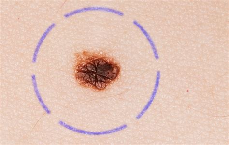 What does melanoma look like in early stages | Symptoms and pictures