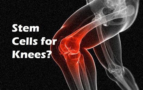 Stem Cells for Knees | CSC - Regenerative Orthopedics