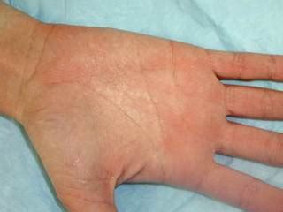 Exposure to moisture leads to palmar rash - The Clinical Advisor