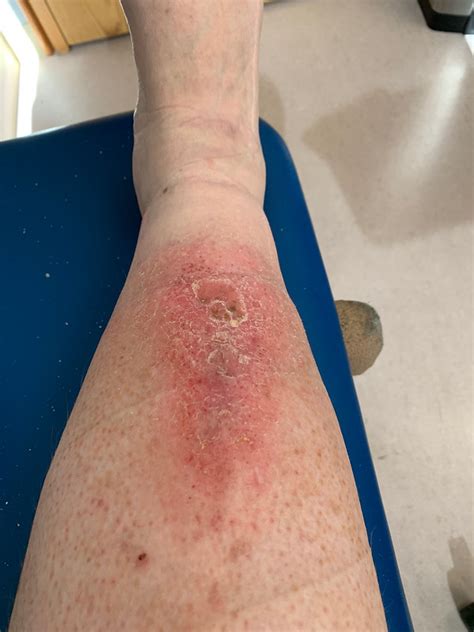 The end of wound care (with warning) – The PolyBlog