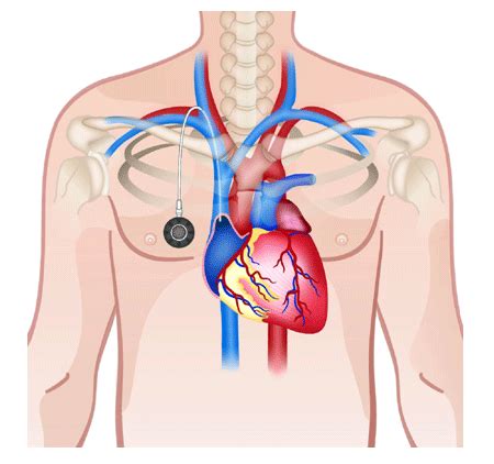 Chemoport Insertion | Varicose veins | Vascular surgeon | Stroke | DVT | Leg gangrene | Cancer