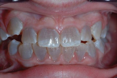 0 Result Images of What Causes Brown Color On Teeth - PNG Image Collection