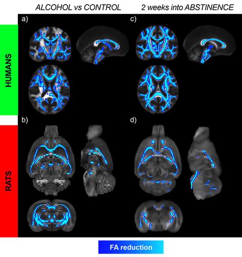 Alcohol-induced brain damage continues after alcohol is stopped